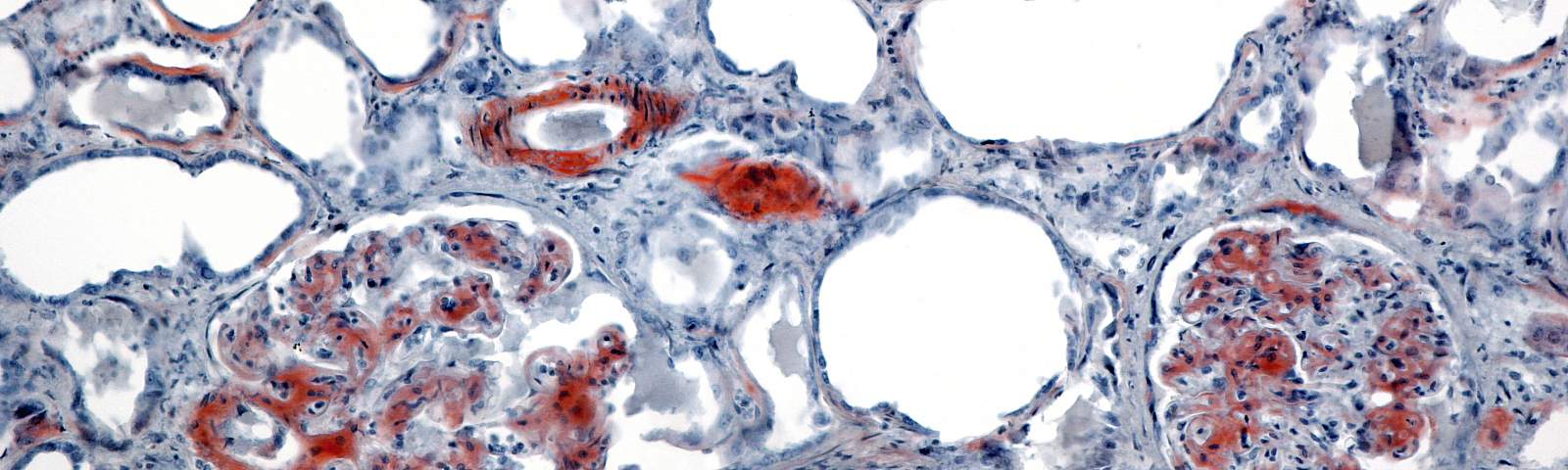 Light micrograph of amyloidosis in a human kidney