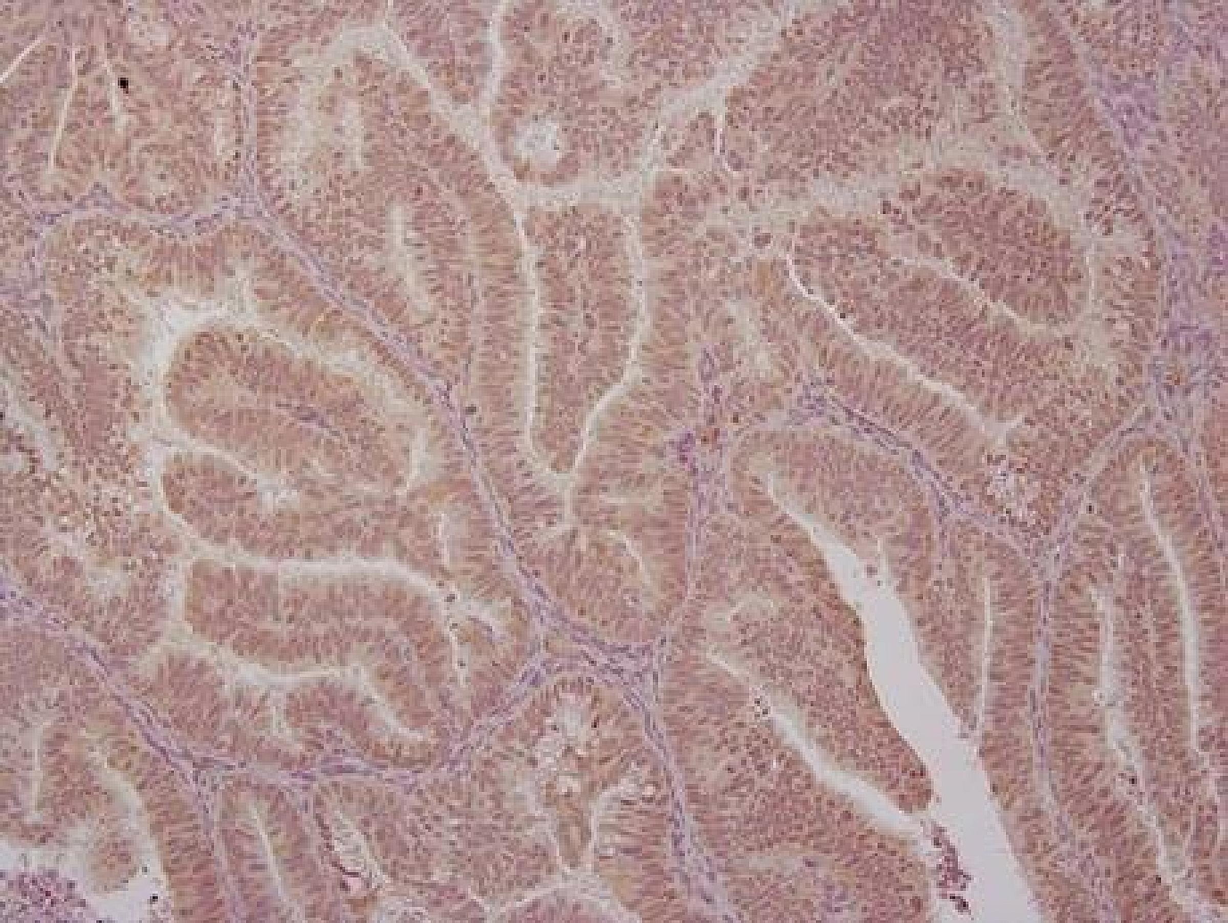 Endometrial cancers donated by patients for research were studied by the Jay Gertz Laboratory. ETV4 (as indicated by brown staining) is present in these samples. Gertz and his colleagues are working to understand the role of ETV4 in endometrial cancer. Image courtesy of the Gertz Lab.