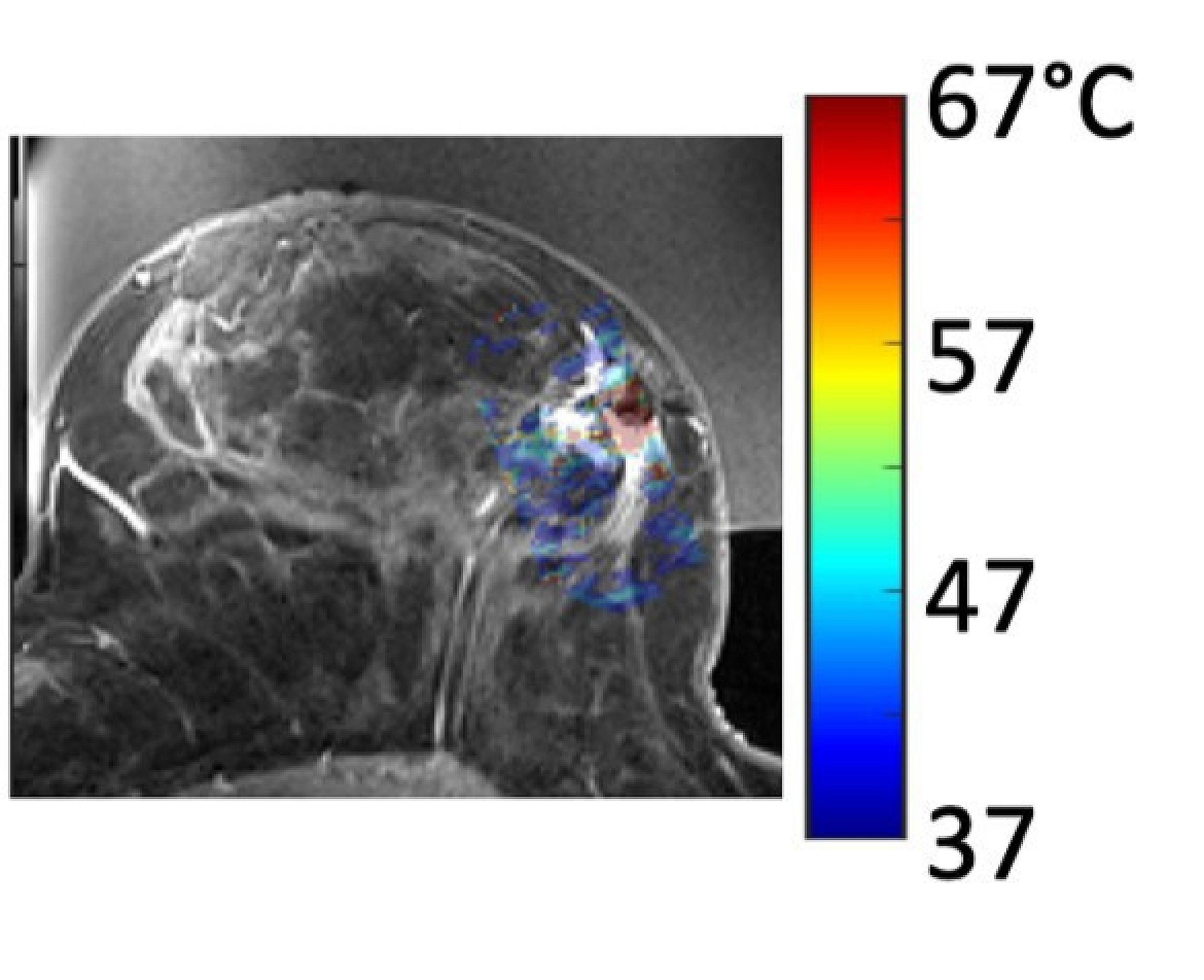 Contrast enhanced T1-weighted image of the breast with the temperature map overlaid. Temperature is monitored in real time with tools developed by Drs. Dennis Parker, Henrik Odéen and Allison Payne.