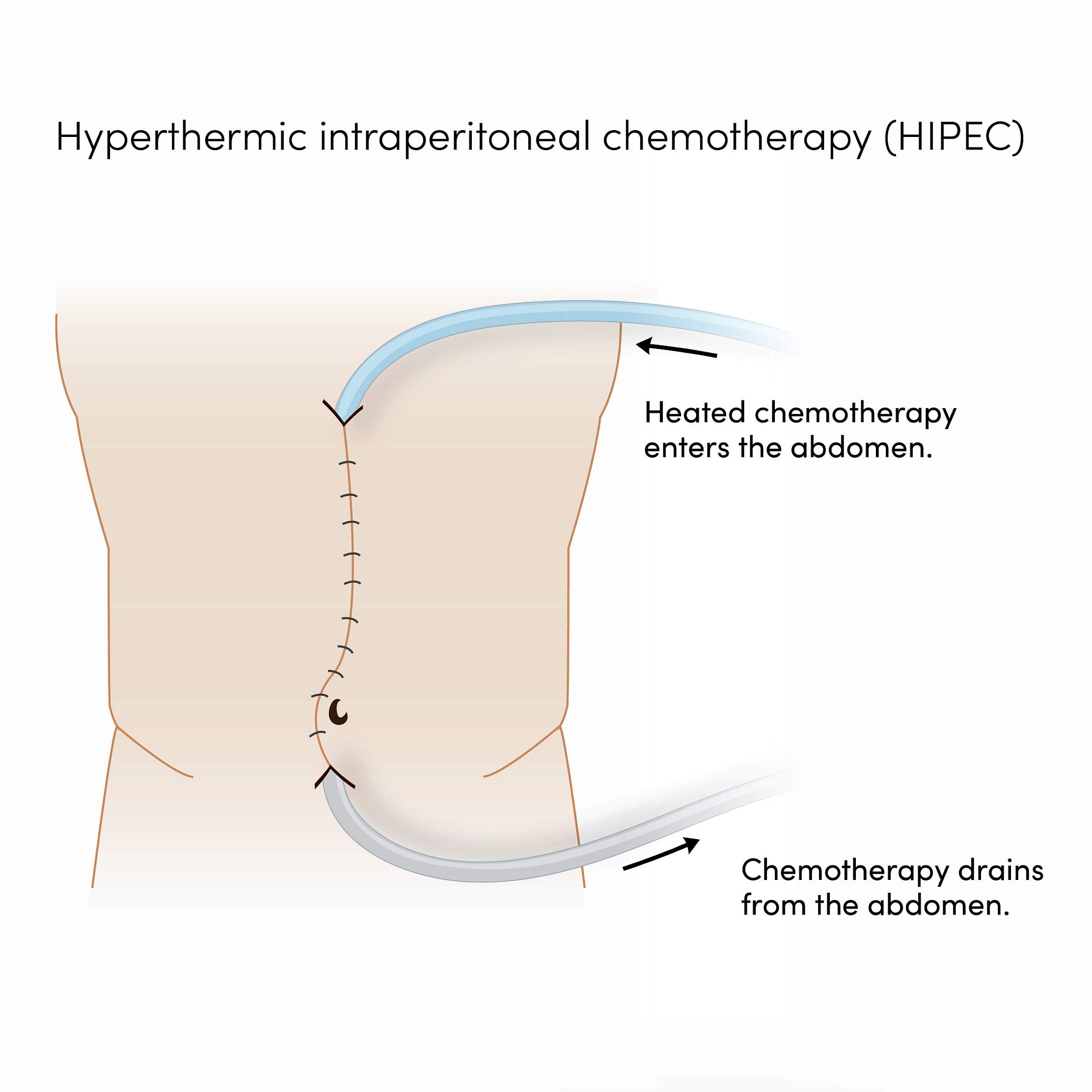 Illustration of a torso with a tube entering and exiting the stomach area to deliver the heated chemotherapy