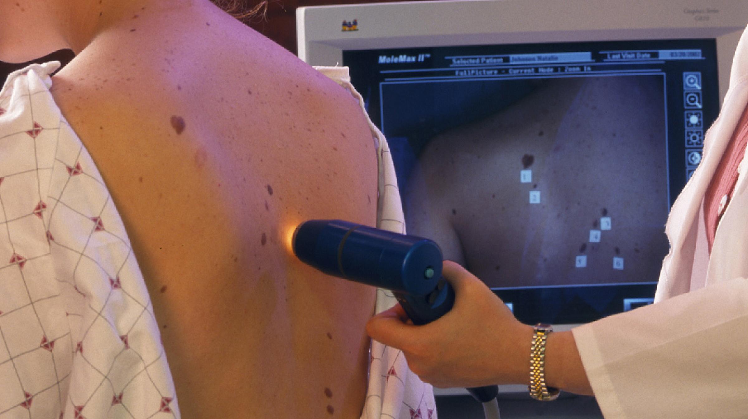 A man receives a skin exam on his back