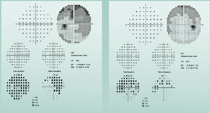 Figure 1. Visual field tests show peripheral visual field abnormalities.