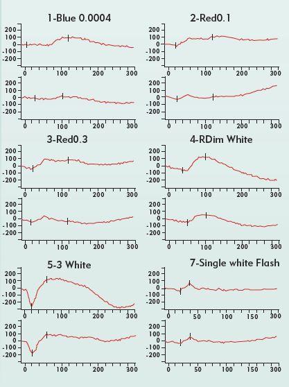Figure 3. Electroretinography is suggestive of birdshot chorioretinopathy. Scotopic dim blue and red flash ERGs are reduced in amplitude 30 percent or more. The patient’s photopic b-wave times are delayed several standard deviations to 35 and 37 msec.