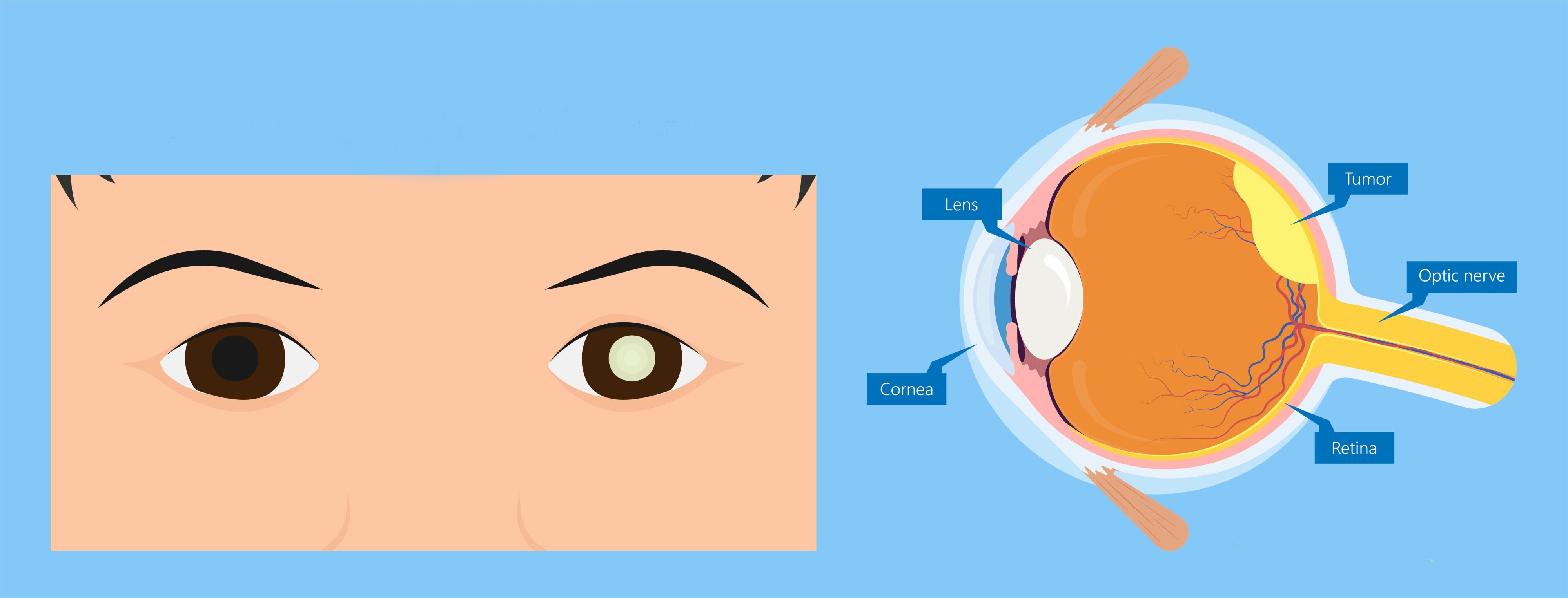 Retinoblastoma graphic