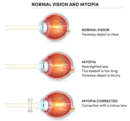 Normal Vision and Myopia