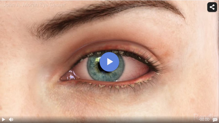 Blepharitis Rendia Video