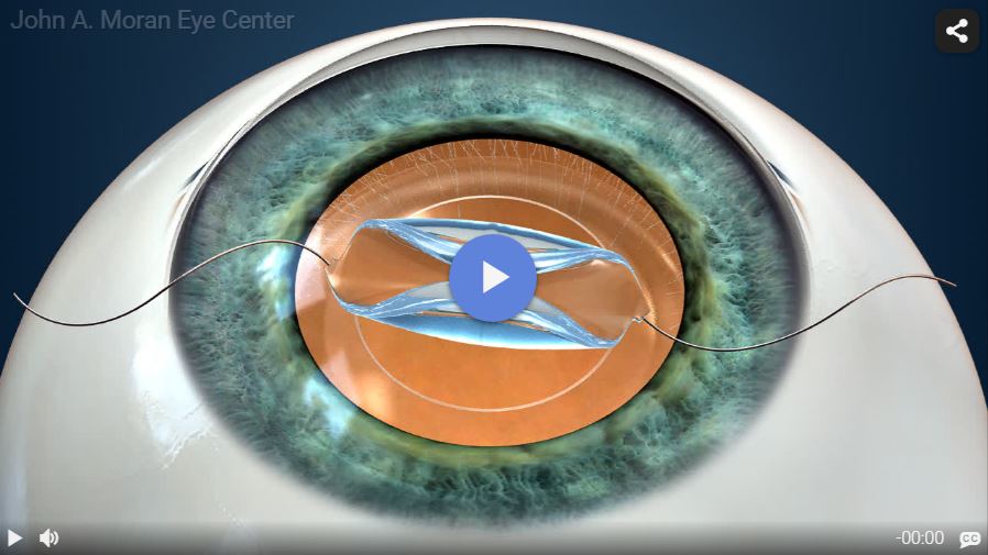Cataract Surgery Introduction Rendia Video
