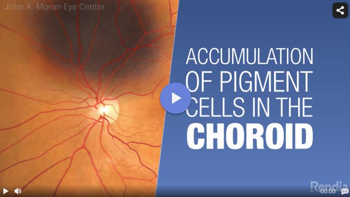 Choroidal Nevus Video link