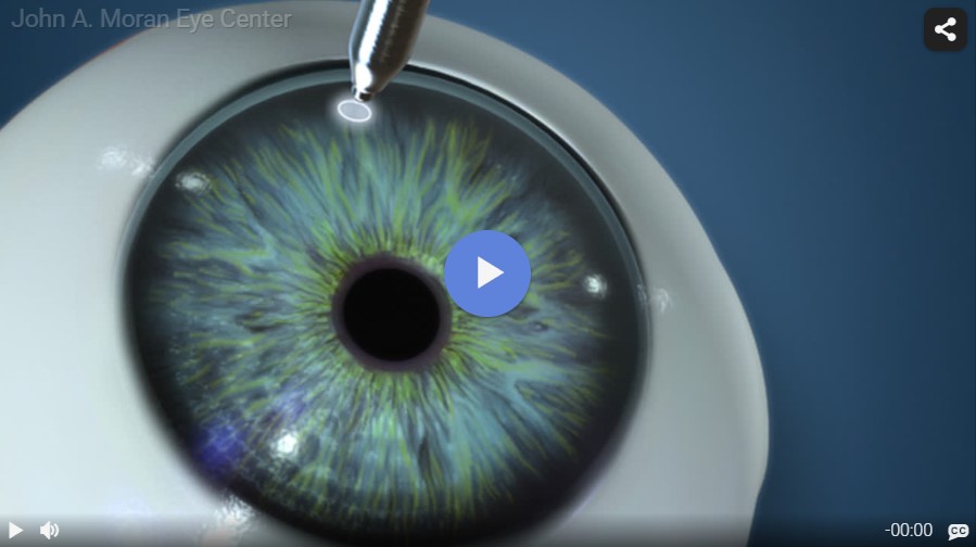 Conductive Keratoplasty Rendia Video