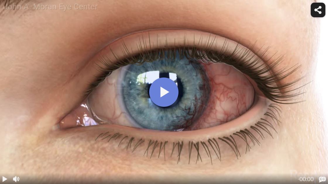 Corneal Neovascularization Rendia Video Card