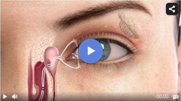 Dacryocystorhinostomy (DCR): Endoscopic Rendia Video