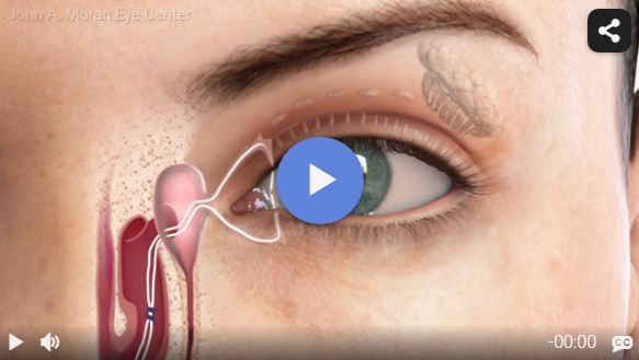 DCR Endoscopic Rendia Video