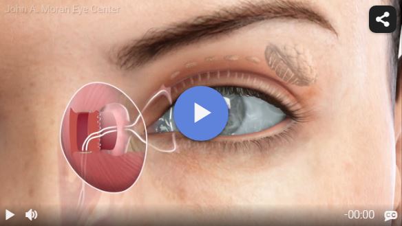 DCR External Approach Rendia Video