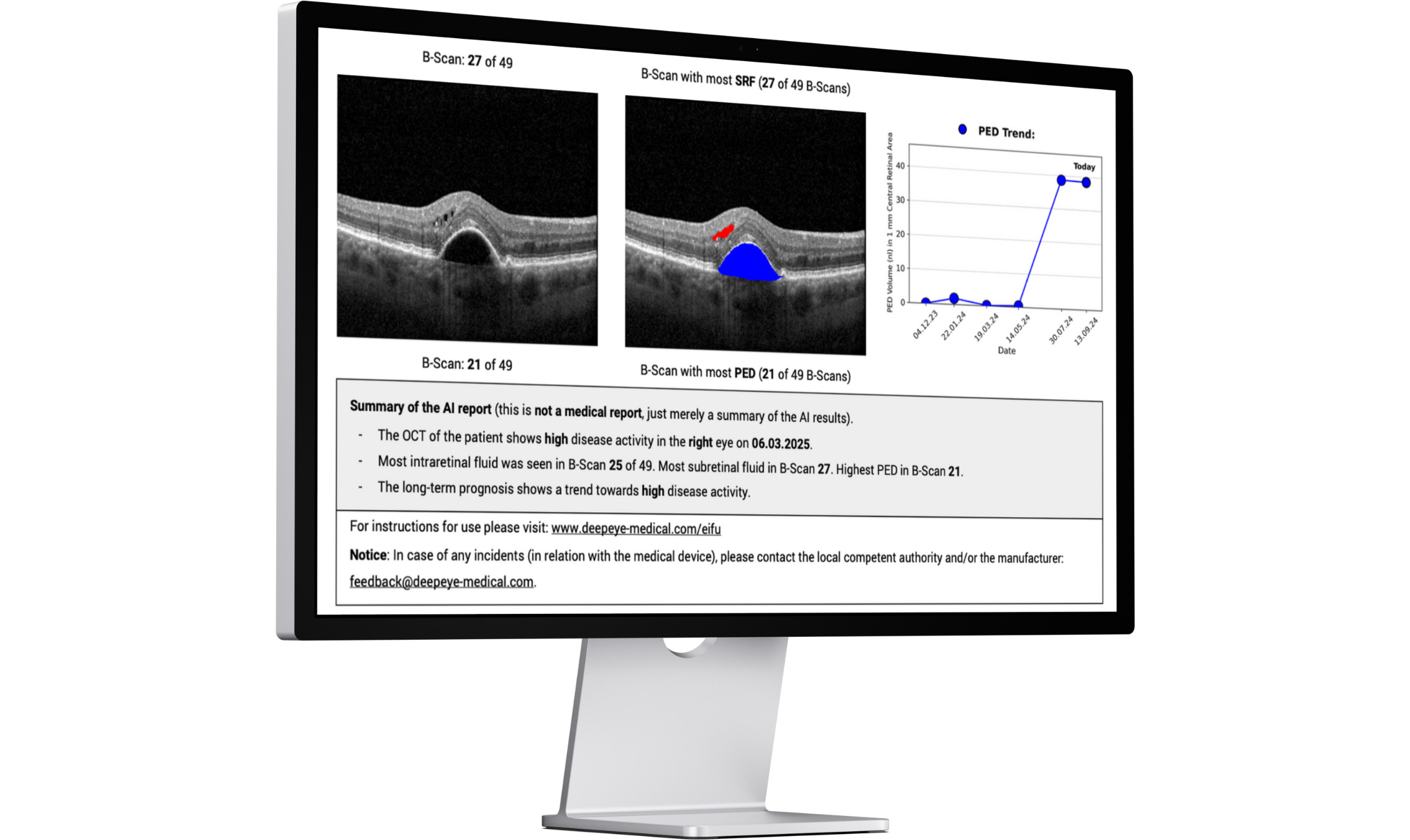 A sample of the deepeye? TPS dashboard for ophthalmology therapy management.