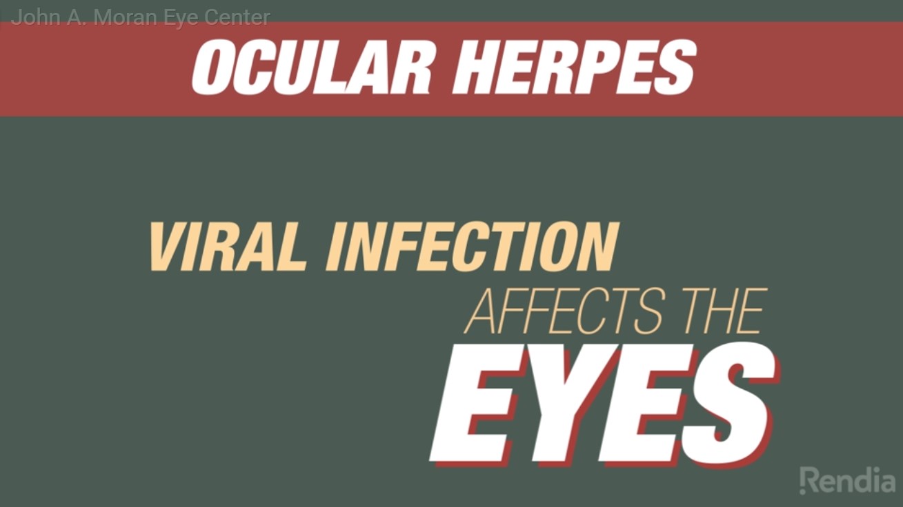 Herpes Simplex Viral Keratitis Rendia