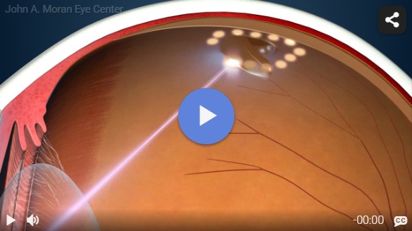 Laser Therapy Rendia Video