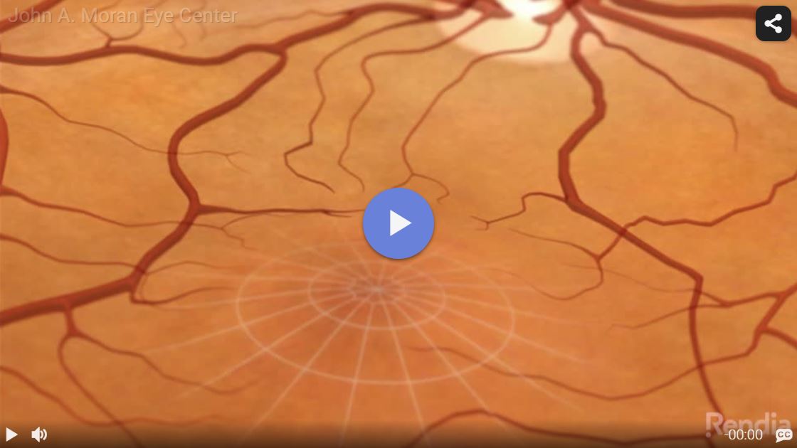 Macular Edema: Overview