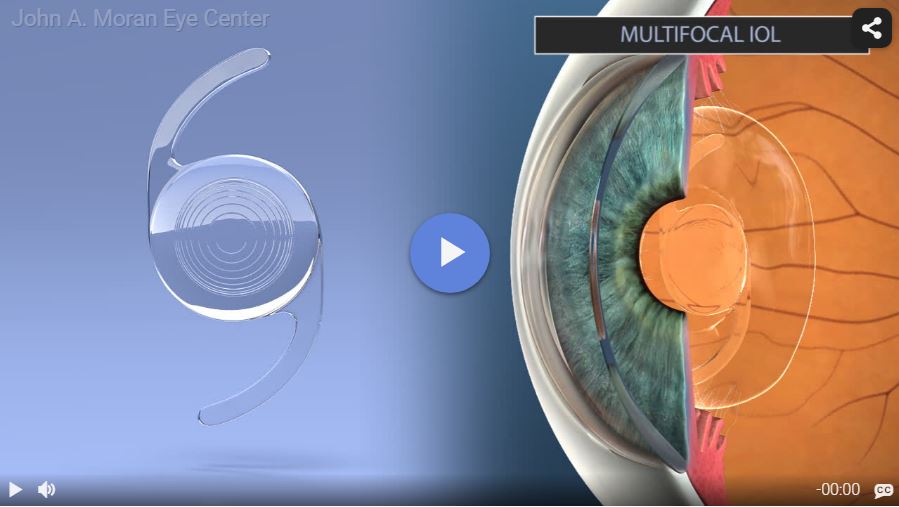 Multifocal IOL Rendia Video