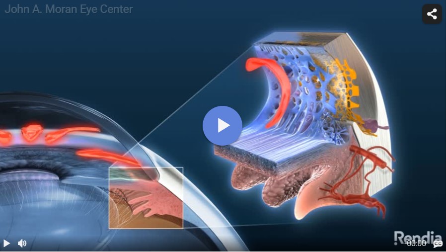Open Angle Glaucoma Rendia Video