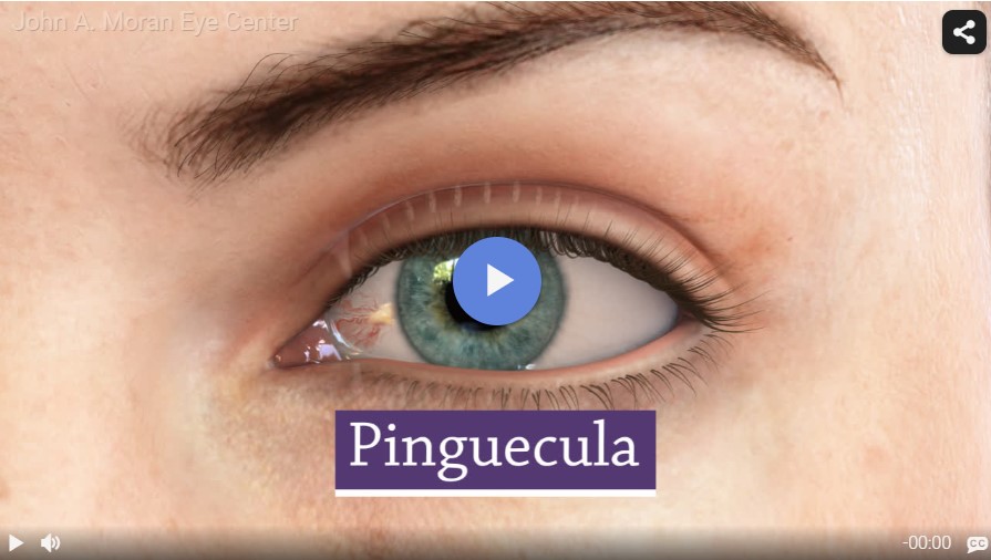Pinguecula Rendia Video
