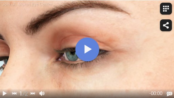 Ptosis Rendia Video