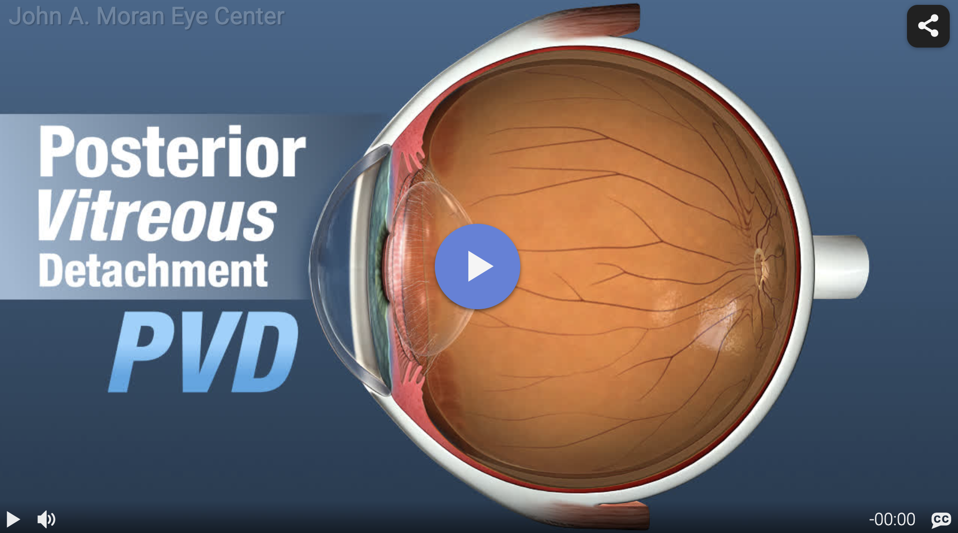 Vitreous Detachment Rendia Video Card