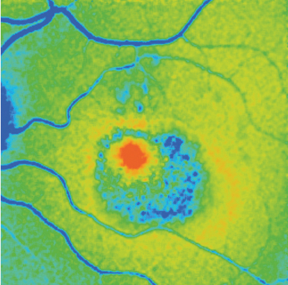 A FLIO scan of hydroxychloroquine toxicity.