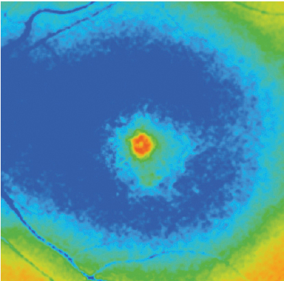 A FLIO scan of Macular Degeneration.