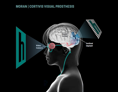 The Utah Electrode Array used in the Moran|Cortivis Visual Prosthesis receives input from a video camera and translates the images into a form of artificial vision. 