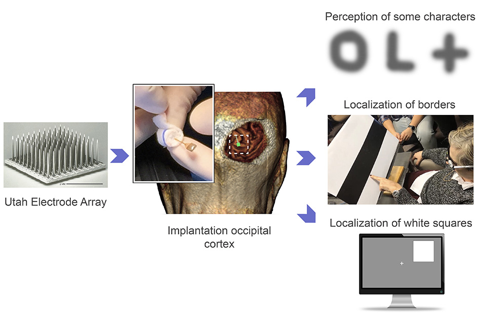 Artificial Vision Array Illustration