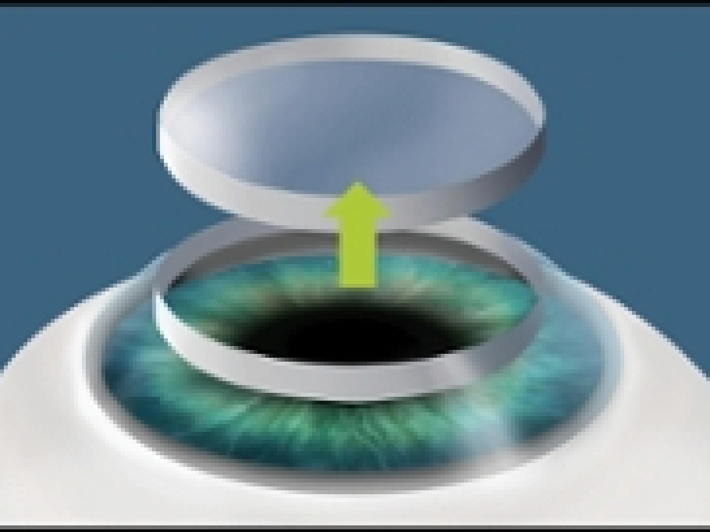 Surgeon removing diseased/damaged cornea