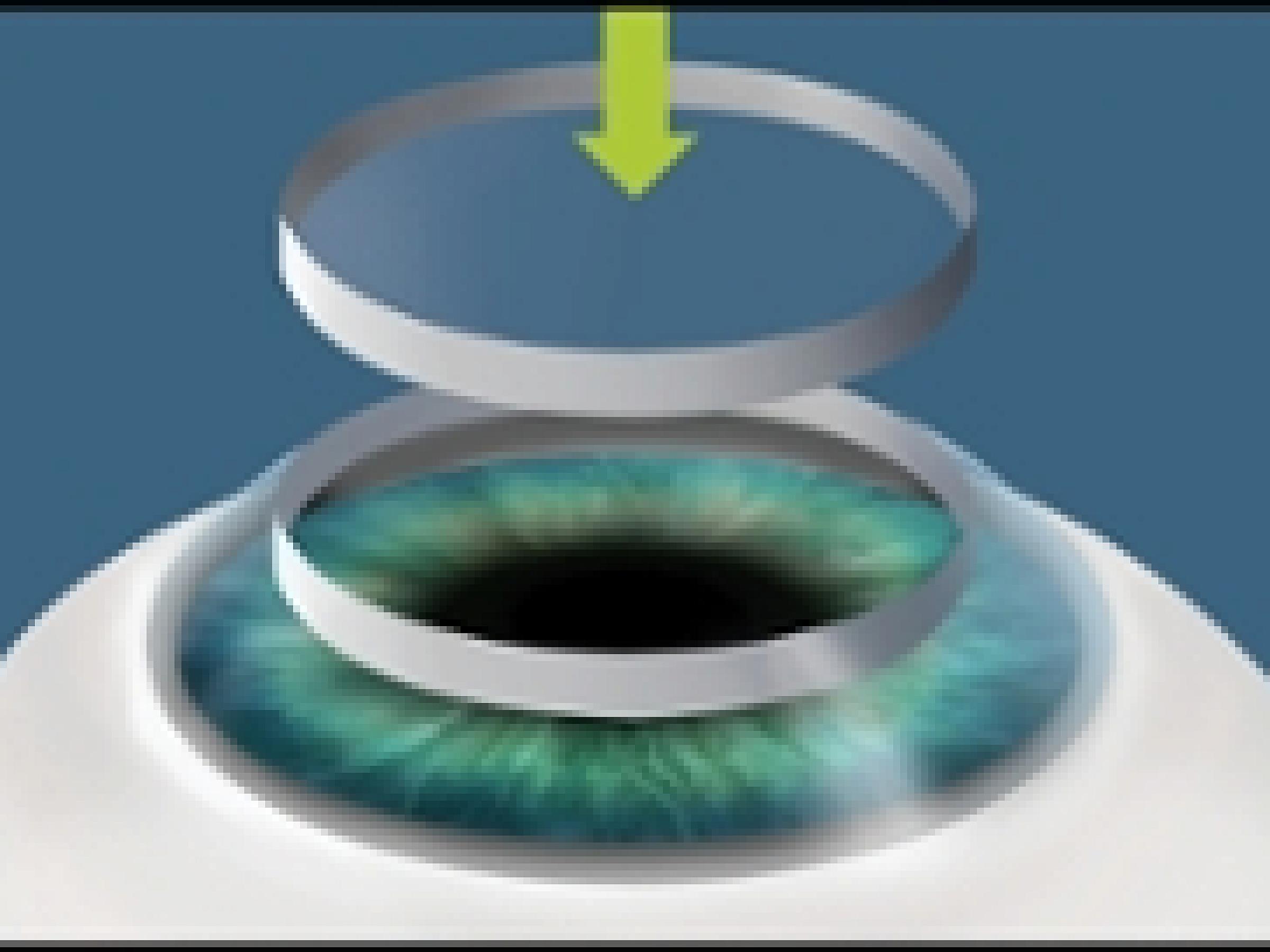 Surgeon placing donor cornea into patient