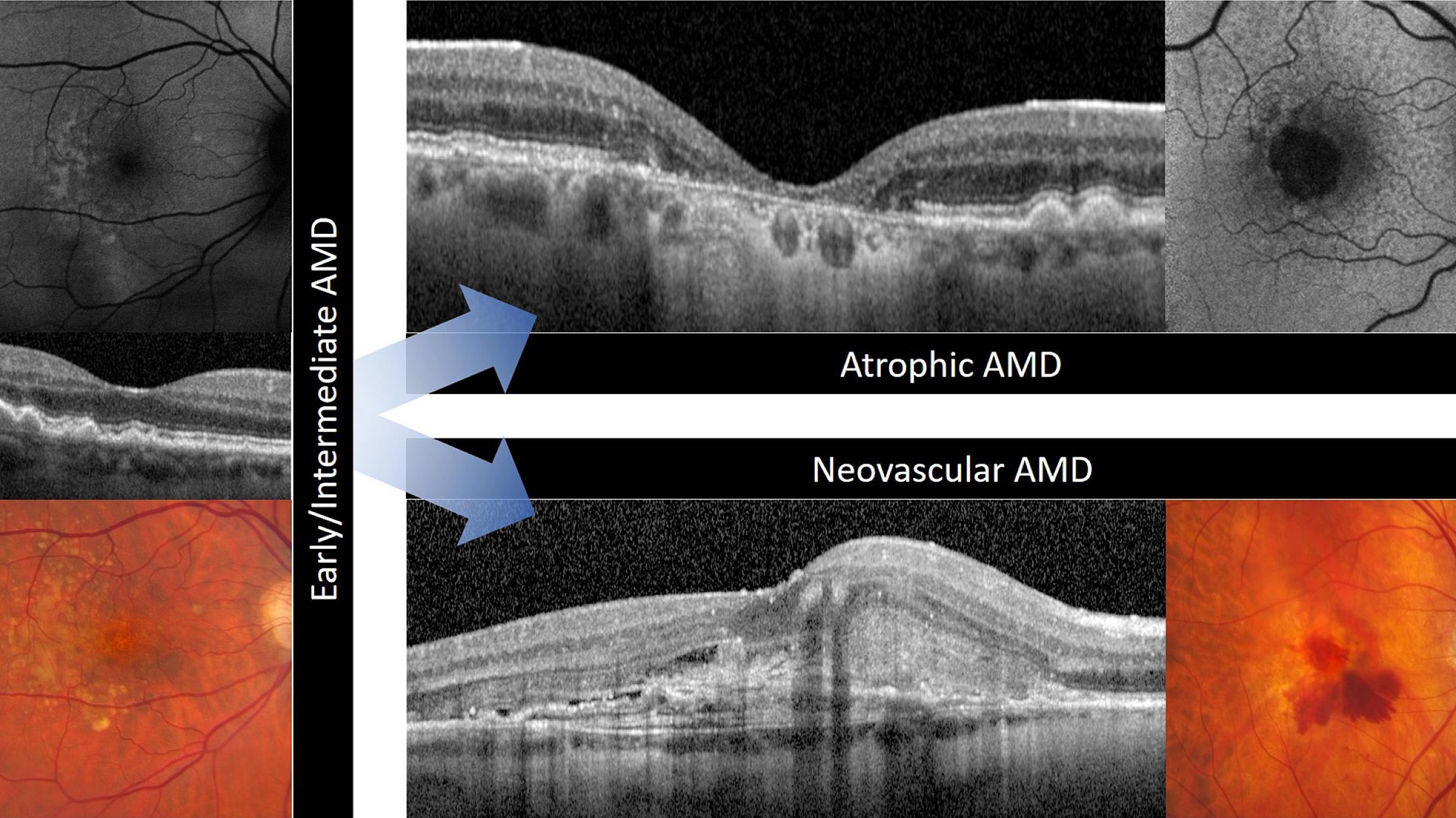 AMD progression images
