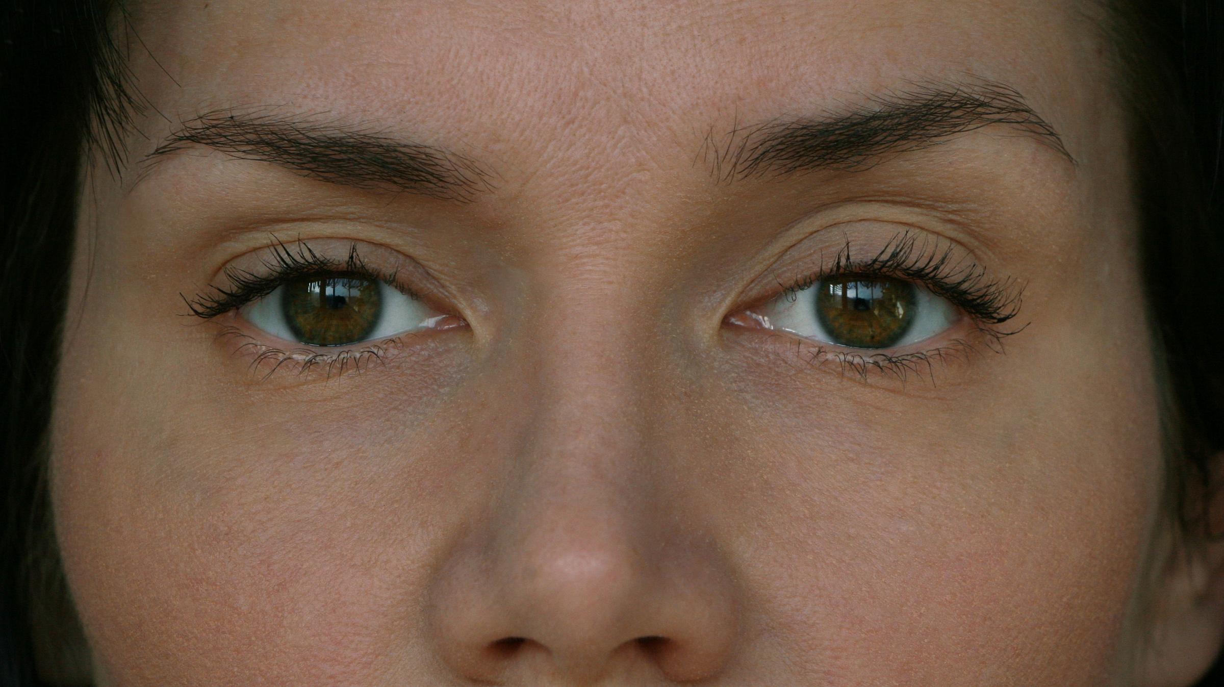 ptosis