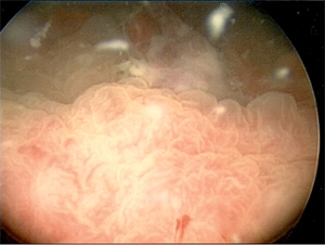 chronic inflammation bladder