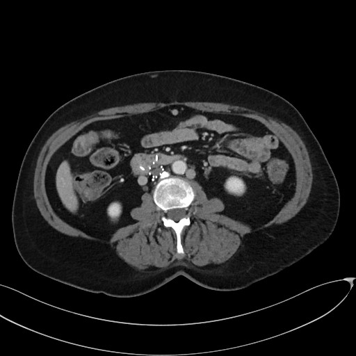 Radiology image of an IVC filter whose legs (the small bright spots) have penetrated the small intestine