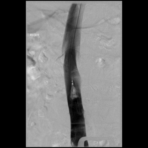 Radiology image showing clot caught in a filter