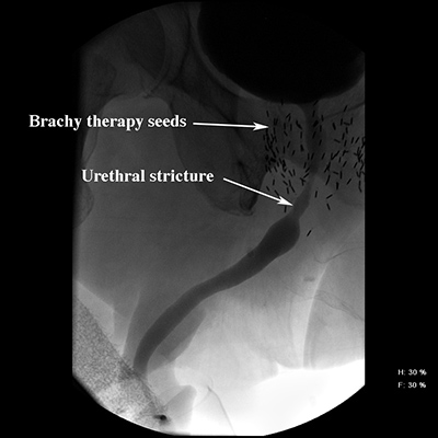 Brachytherapy treatment
