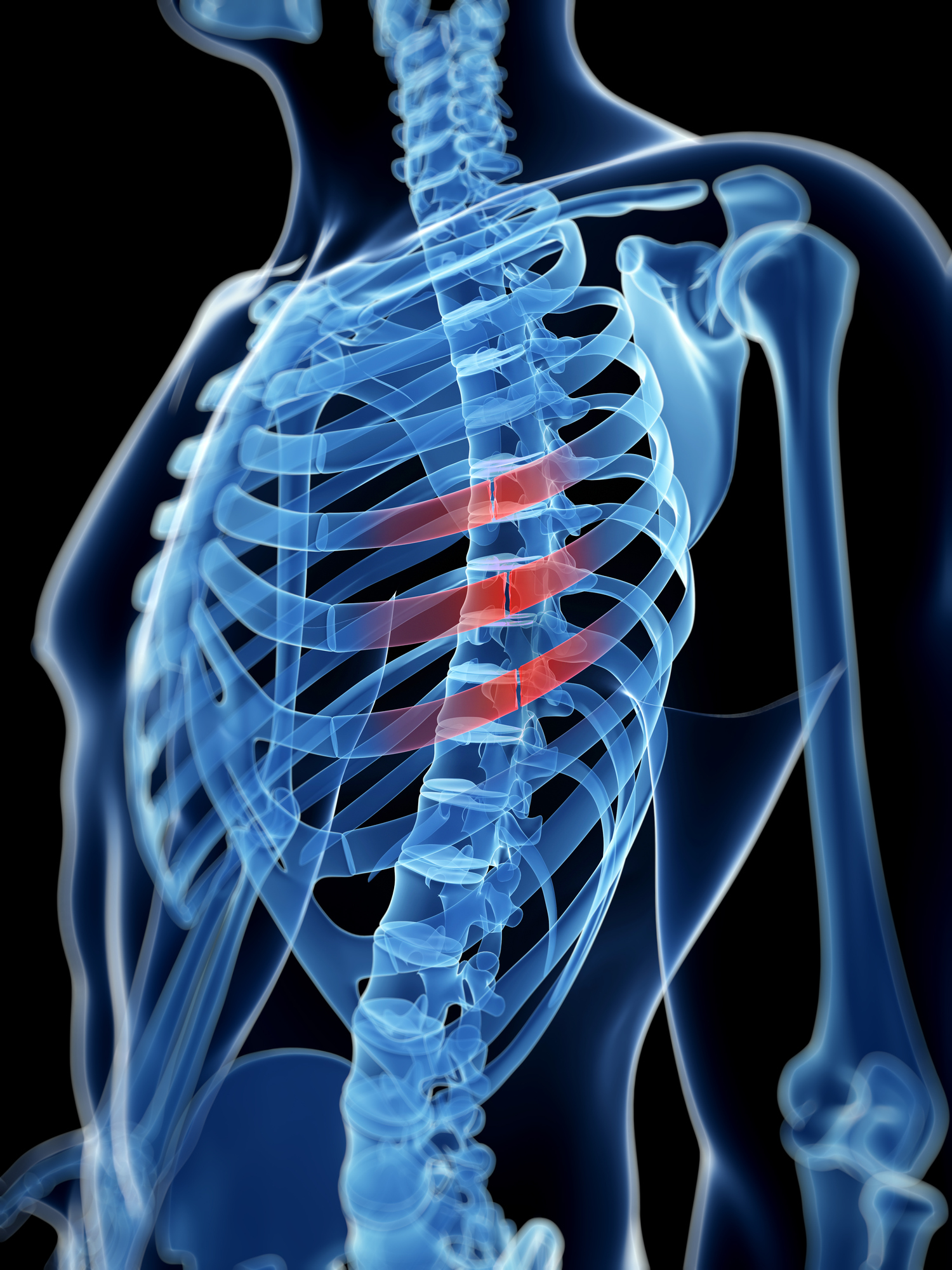 Fractured Ribs Still Painful After 2 Months? You May Need Surgery