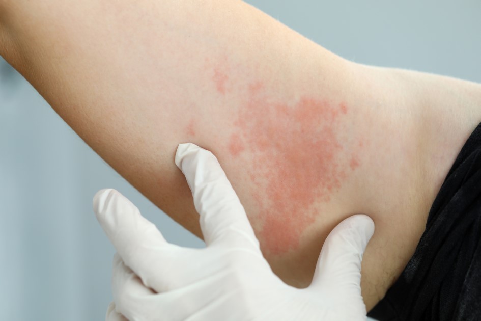 Shingles: What You Need to Know and Why it Matters to Your Health