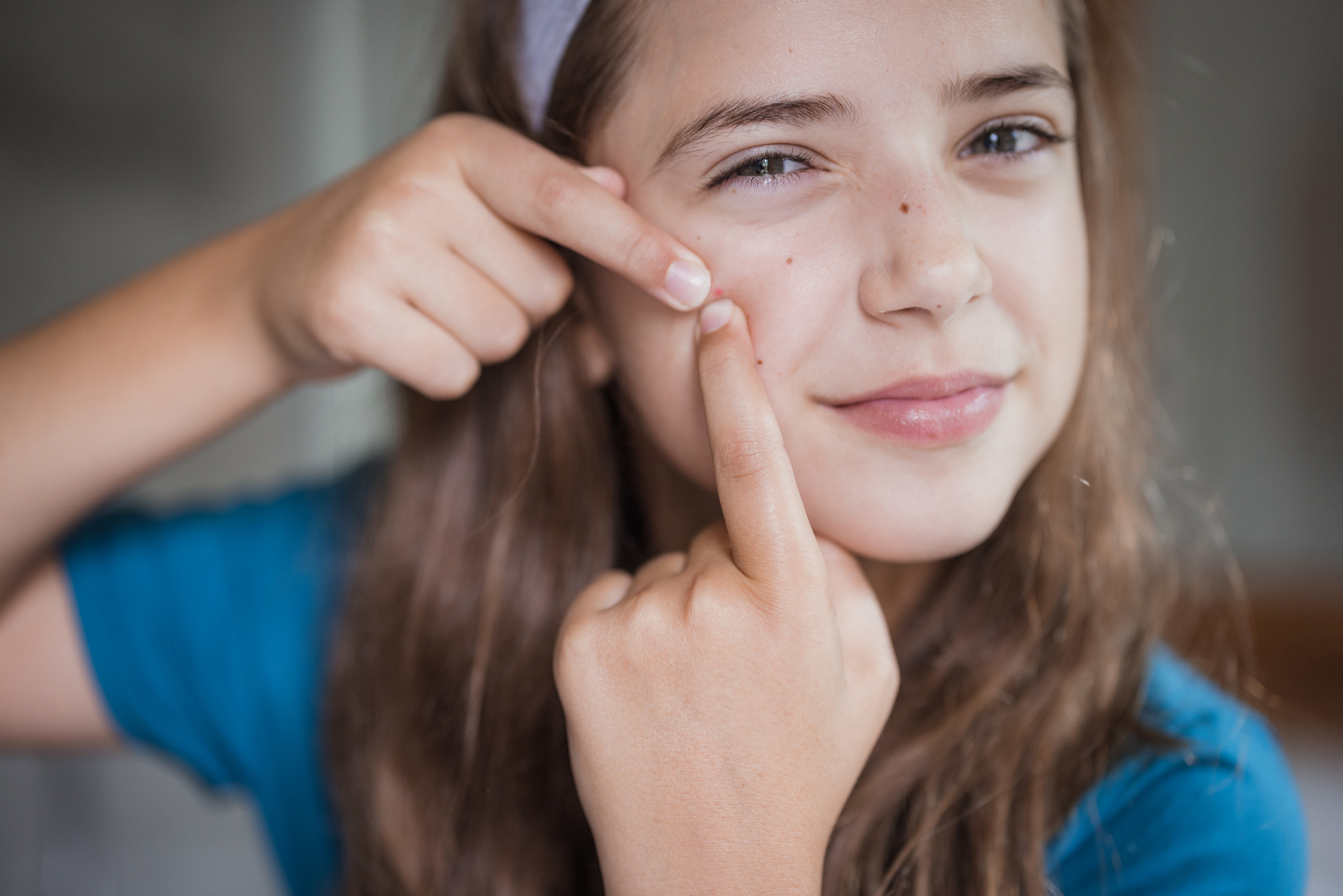 Debunking Old Wives' Tales: 5 Myths About Treating Acne