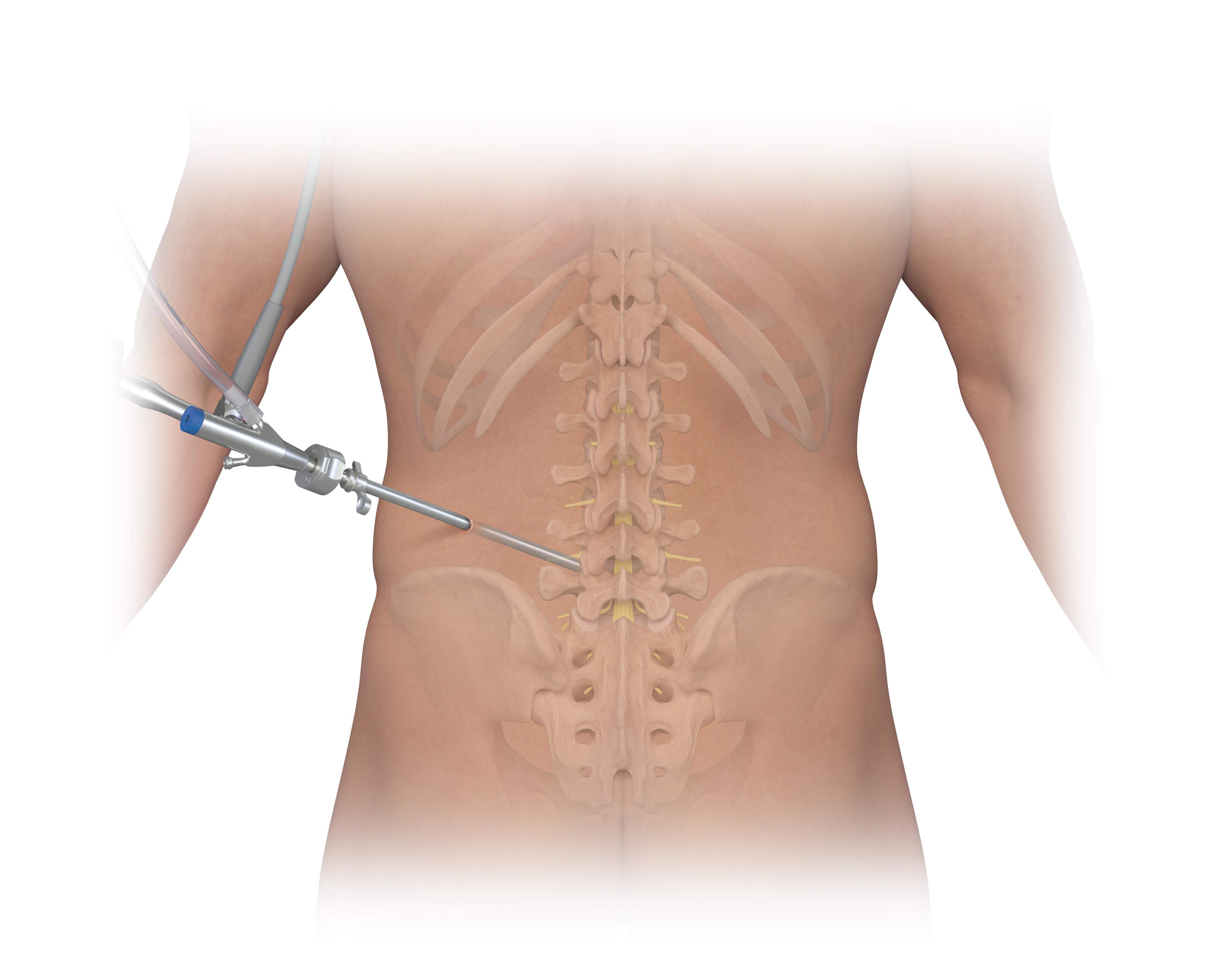 Illustration of a skeletal spine with an endoscope entering the spine