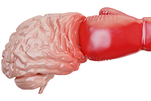 Impact Concussion Graphic