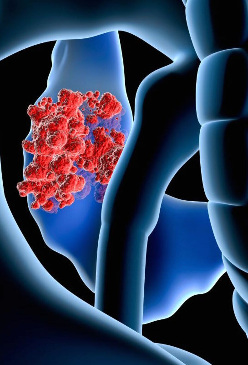 Neuroendocrine Pancreatic Tumor Treatment Options