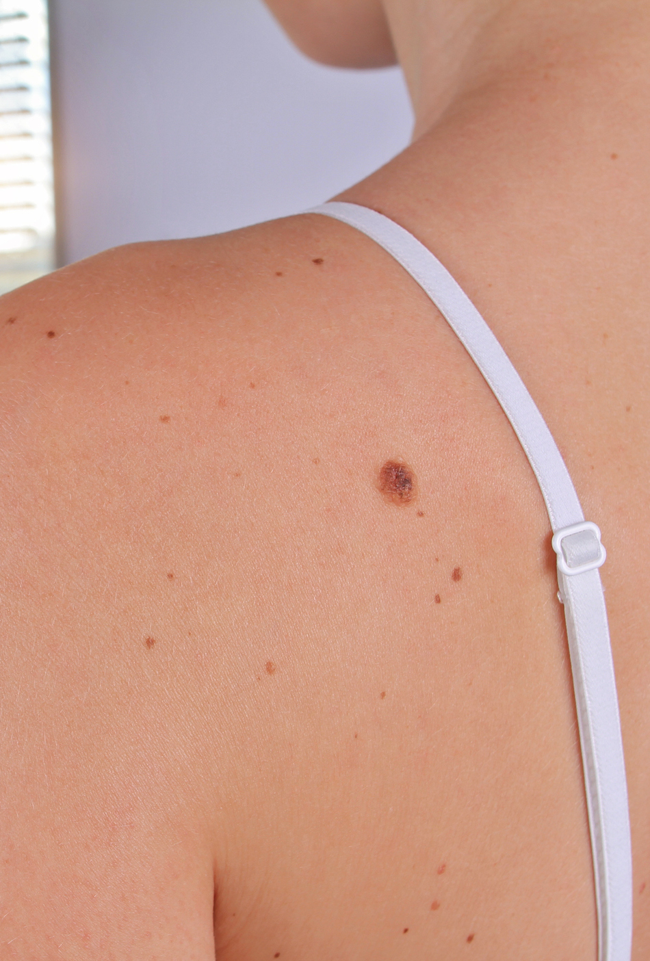 Mole Mapping: What it is and Why You Should Be Mapped