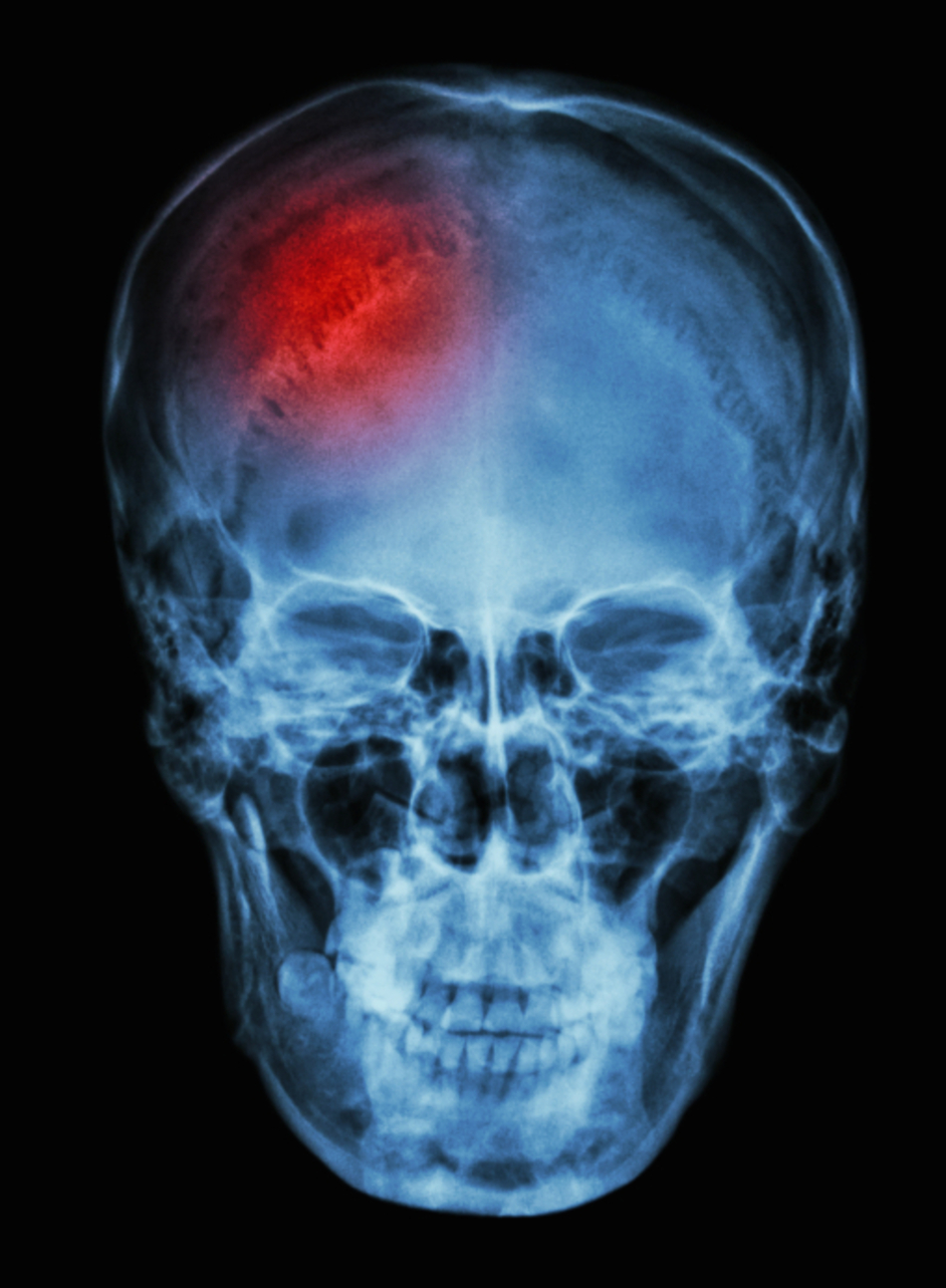 Experiencing & Recovering from Stroke at a Young Age