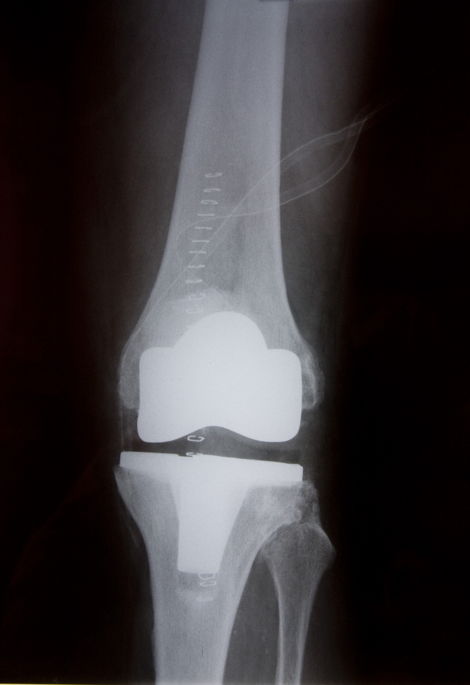 Do You Need a Hip or Knee Revision?