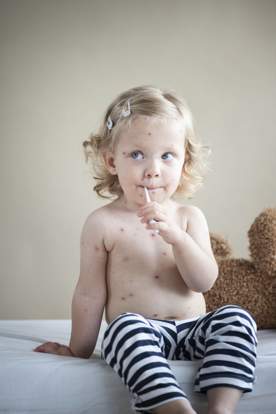 Debunking Old Wives' Tales: Chicken Pox