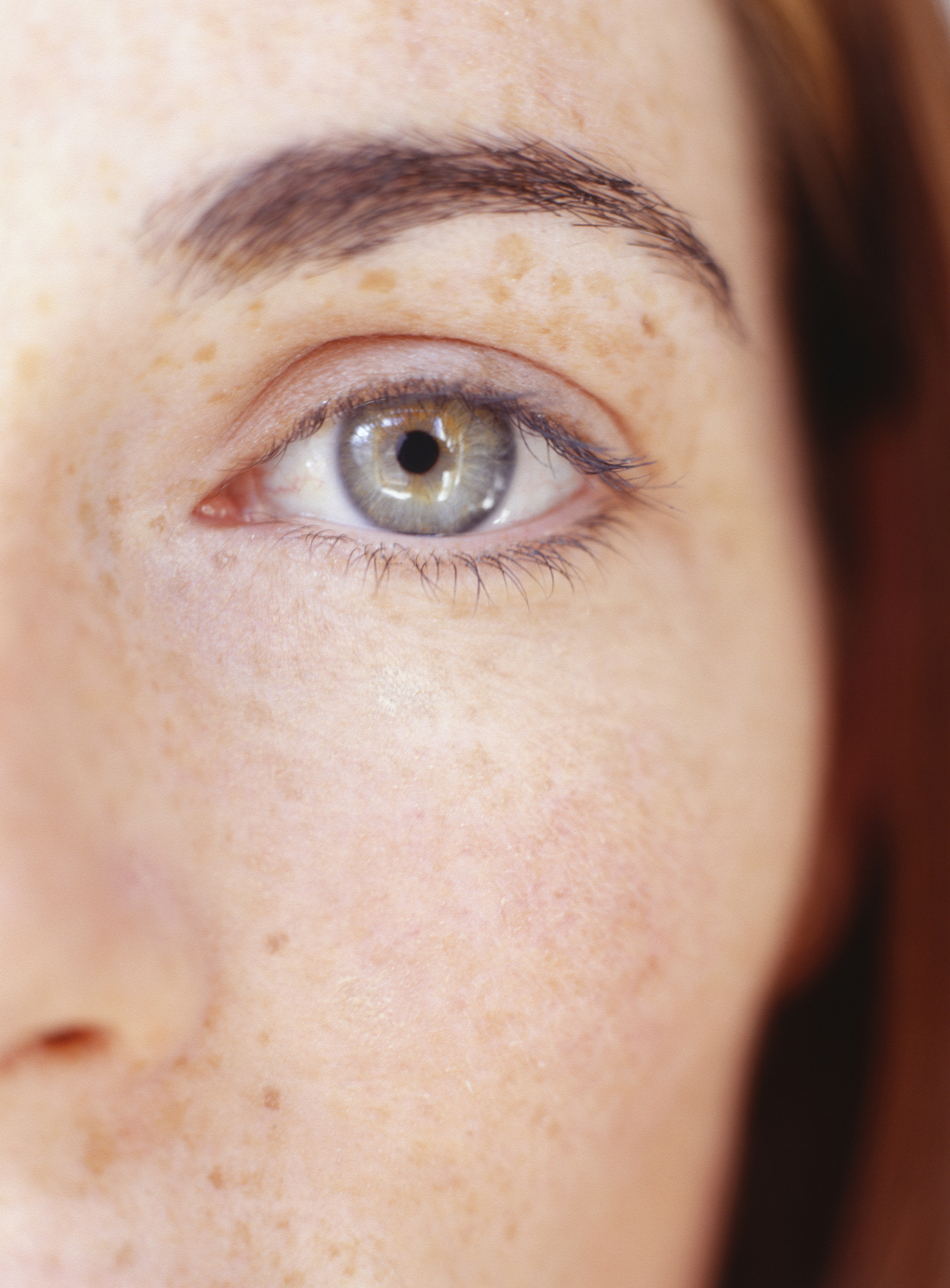 How to Get Rid of Floaters in My Eyes?
