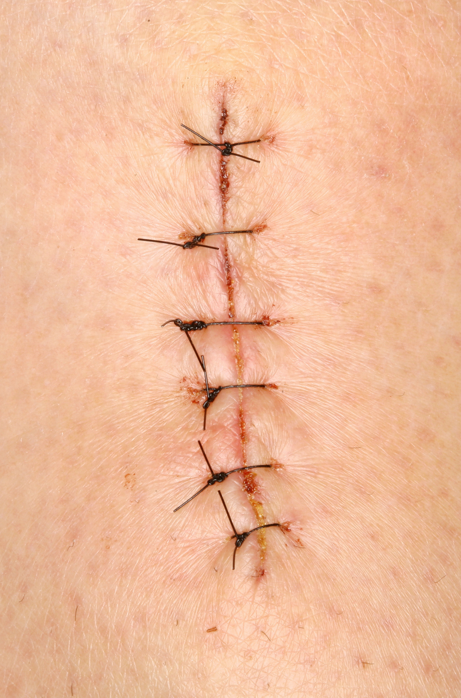 Staples, Stitches or Glue for Treating Large Cuts?